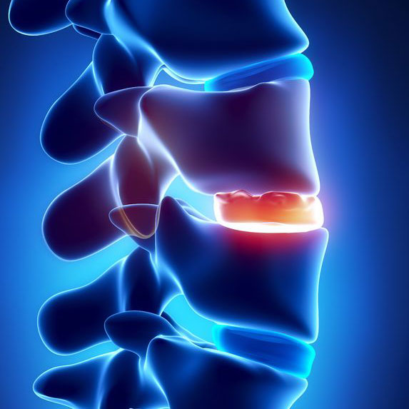 Medical illustration showing spinal disc injury